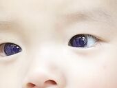 В Таиланде посинели глаза у кареглазого младенца после лечения от COVID-19 фавипиравиром